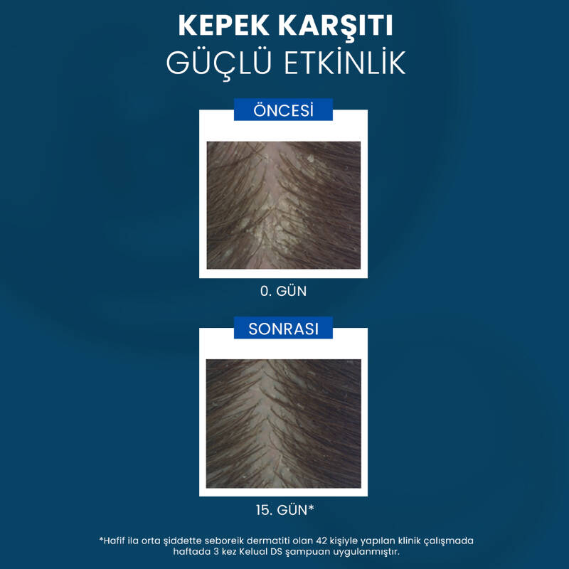 Ducray Kelual DS İnatçı Kepek Karşıtı Şampuan 100 ml - 4